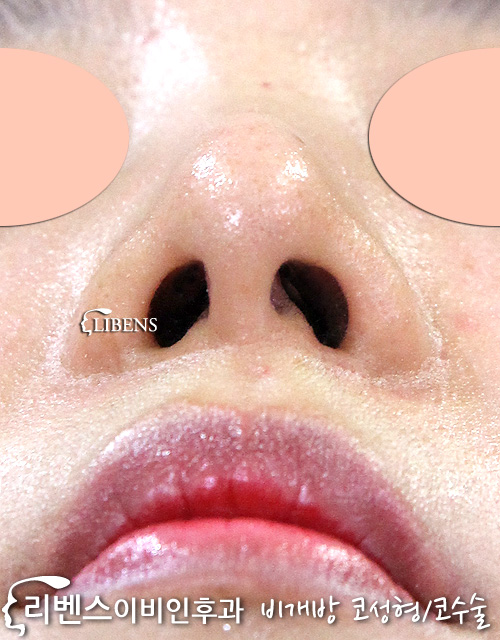 매부리코 매부리코 코끝 성형 수술 콧볼 축소 무보형물 성형 s580